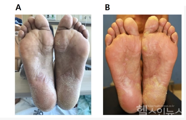 골수 유래 중간엽 줄기세포 치료 전후의 환자 피부 외양 변화 (가톨릭대학교 서울성모병원 제공)