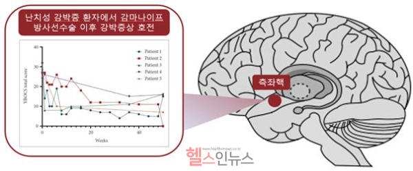 측좌핵에 시행한 감마나이프 방사선 수술 후 주별 YBOCS 점수 추세(완전 반응 환자군에서는 감마나이프 방사선 수술 후 35% 이상의 YBOCS 점수 감소를 보임)