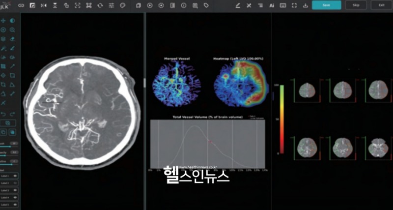 JLK-LVO(대혈관폐색 검출 솔루션) 모습 (제이엘케이 제공)