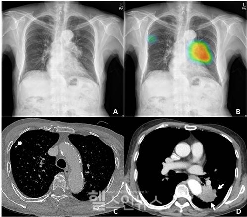 인공지능(AI) 기반 흉부 방사선 사진 분석 (서울보라매병원 제공)