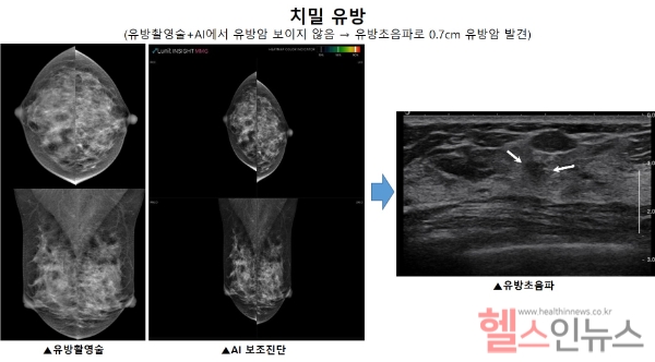 치밀 유방에서 유방초음파를 통한 유방암(흰색 화살표) 발견