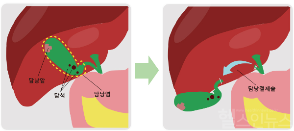 다양한 담낭질환과 담낭절제술의 모식도. 최근에는 개복수술보다 흉터가 남지 않고 출혈과 통증이 적으며 회복이 빠른 복강경 수술, 로봇수술 등이 시행되고 있다. (순천향대 부천병원 제공)
