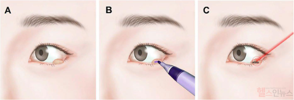 신현진 교수가 개발한 레이저를 이용한 눈꺼풀 종양 제거술은 눈꺼풀 종양(A)를 보라색 마킹펜으로 염색(B) 후, 레이저를 조사해 종양을 제거하는 방법으로 3분 정도의 짧은 시술시간과 칼로 절개 없이 진행해 통증은 최소화 하면서 안전하고 빠르게 종양을 제거할 수 있다. (건국대병원 제공)