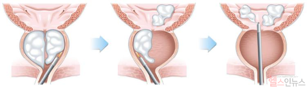 홀렙수술 모식도 (서울대병원 제공)