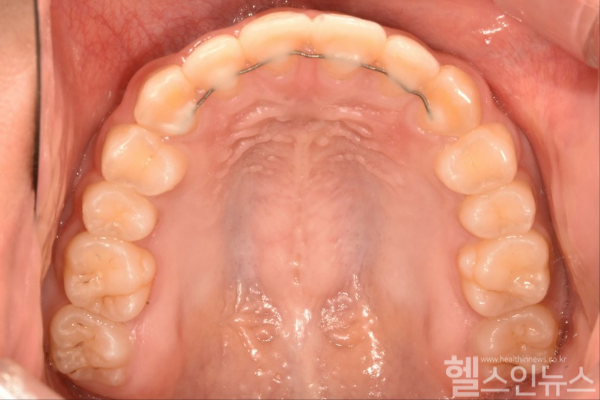 고정식 유지장치가 부착된 모습 (서울대치과병원 제공)