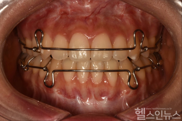 가철식 유지장치 착용한 모습 (서울대치과병원 제공)