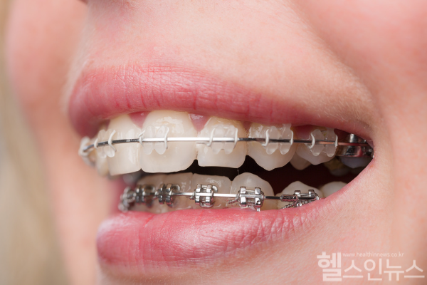 치아교정 후 관리 제대로 하지 않으면 치아 배열 바뀌고 교합 관계까지 변할 수 있어 주의 필요해... 일정 기간 동안 적극적인 유지·관리 진행해야 (클립아트코리아)