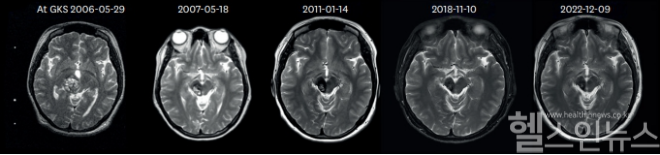 감마나이프 방사선 수술(GKS) 후 우측 중뇌 해면상 혈관종의 크기 변화를 보여주는 MRI: 수술 후 뇌 해면상 혈관종이 점진적으로 축소되어 용적 감소와 병변의 소실이 관찰됨 (서울대병원 제공)