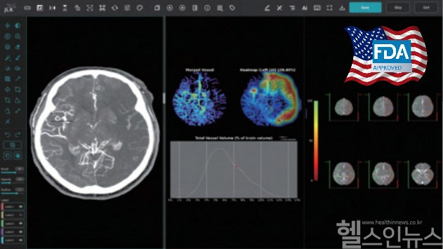 제이엘케이 대혈관폐색 검출 솔루션 JLK-LVO (제이엘케이 제공)