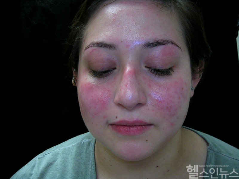 루푸스 환자 모습 (클립아트코리아 제공)