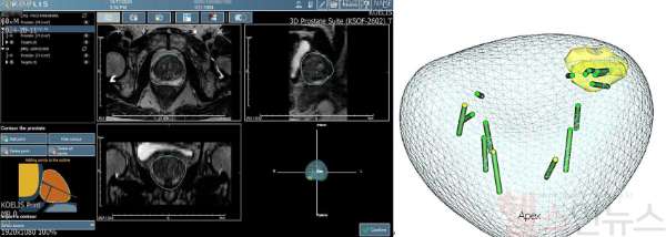 SNU건전비뇨의학과, 원데이 MRI 연동 표적 조직검사 시행 (SNU건전비뇨의학과 제공)