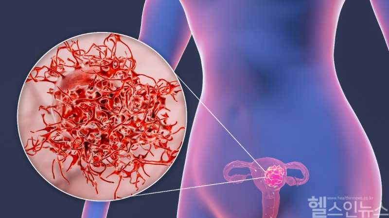 BRCA 유전자 변이로 인해 발생할 수 있는 난소암은 조기 진단이 어려워 진행된 상태에서 발견되는 경우가 많다. (클립아트코리아 제공)