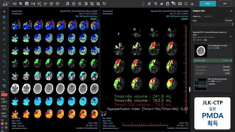 제이엘케이 뇌졸중 AI 솔루션 JLK-CTP
