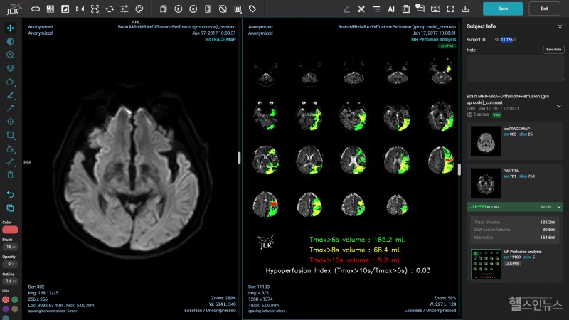 제이엘케이 뇌졸중 AI 솔루션 JLK-PWI (제이엘케이 제공)