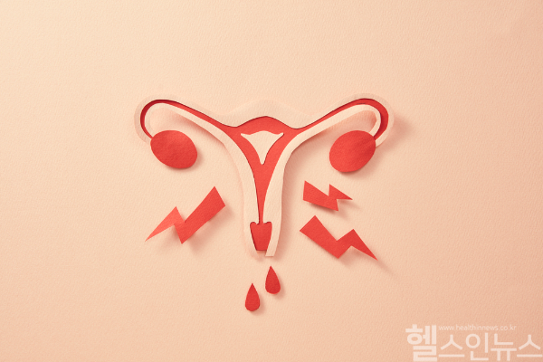 다양한 이유로 발생할 수 있는 부정출혈... 그 중 가장 흔한 여성질환은 양성종양인 '자궁근종' (클립아트코리아)