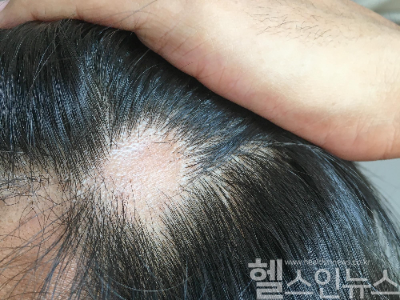 흉터 재건 모발이식 (참닥터의원 제공)