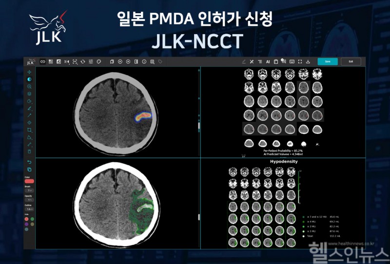 제이엘케이는 일본 PMDA에 뇌졸중 AI 솔루션 ‘JLK-NCCT’의 인허가 신청을 했다고 5일 밝혔다. (제이엘케이 제공)