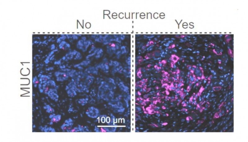 진은 그중 하나인 MUC1(보라색)이 많이 발현된 저산소 암세포(오른쪽)와 발현이 차단된 암세포(연합 제공)