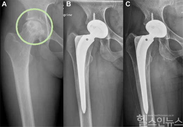 3세대 세라믹 인공고관절 전치환술을 받은 27세 대퇴골두 골괴사 여성의 단순 방사선 사진 (A) 수술 전 오른쪽 대퇴골두 함몰(연두색 원) (B, C) 수술 후 각각 10년째, 26년째. 주요 부작용 없이 인공고관절이 잘 유지됨. (서울대병원 제공)