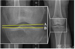 (X-ray 이미지) 관절선 수렴각: A선과 B선이 이루는 각도로 무릎 관절의 정렬 상태를 평가하는 지표로 사용됨 (서울대병원 제공)