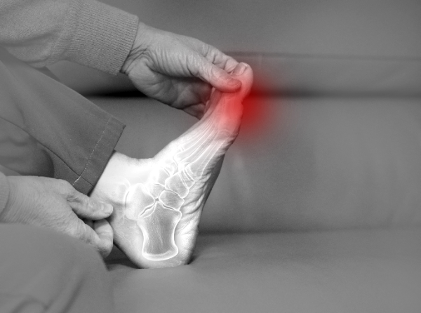 기온이 낮아질수록 혈관이 수축하고 체내 요산 축적이 쉽게 일어나 통풍 발생률이 높아진다. 식습관과 생활습관 문제로 통풍 발병 연령이 점차 낮아져 각별한 관심과 관리가 필요하다. (클립아트코리아 제공)