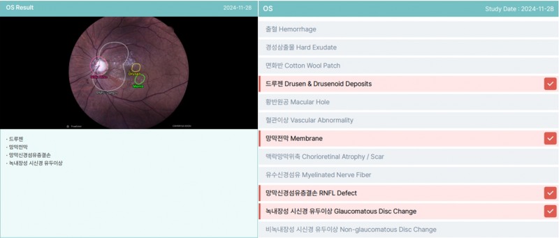 사진=천안김안과 천안역본점 검사결과지