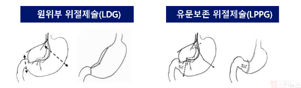 복강경 원위부 위절제술(LDG) 및 복강경 유문보존 위절제술(LPPG) 모식도 (서울대병원 제공)