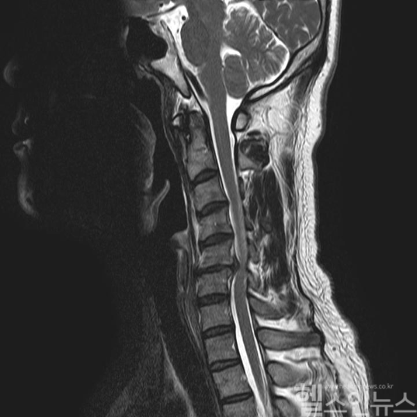 겨울철 안 좋은 자세는 목디스크 증상을 심화할 수 있다 (연세사랑병원 제공)