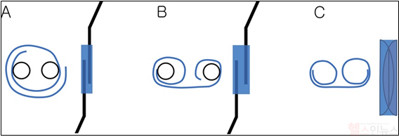 두 개의 캐뉼라를 데세메막의 양 끝에 삽입하여 단일 롤 형태(single roll)를 족자 모양의 더블 롤(double roll) 형태로 변환하는 과정 (여의도성모병원 제공)