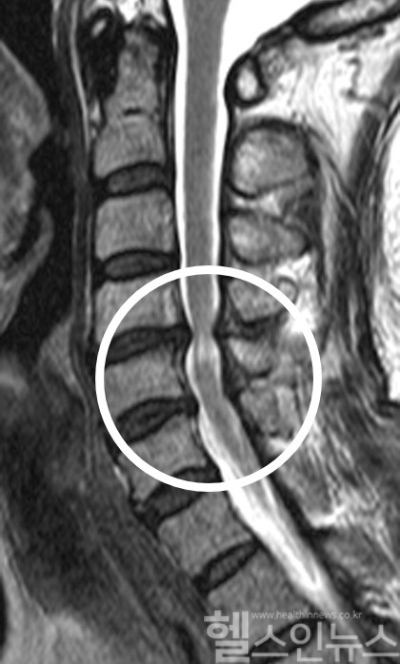 경추척수증 환자의 경추 MRI. 경추 부위 척수신경(흰색 동그라미)이 압박을 받아 좁아진 모습이 나타남. (서울대병원 제공)