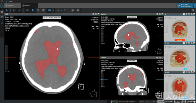 혁신의료기술로 선정된 AI 뇌출혈 진단 제품 AVIEW NeuroCAD (코어라인소프트 제공)