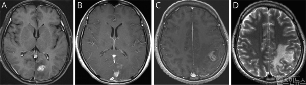 (A) 초기 뇌 MRI에서 좌측 후두엽에 조영증강된 종괴가 관찰됨 (B) 3개월 뒤 시행한 뇌 MRI에서 좌측 후두엽의 종괴가 사라짐 (C) 8개월 뒤 시행한 뇌 MRI에서 좌측 두정엽에 새롭게 조영증강된 종괴가 발견됨 (D) 좌측 두정엽 종괴 주변에 심한 뇌부종이 동반된 모습이 확인됨 (서울대병원 제공)