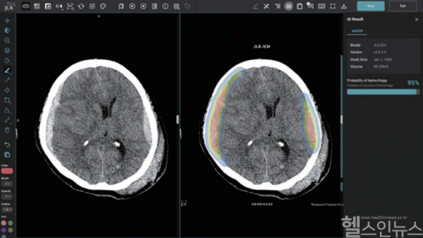 제이엘케이 뇌출혈 검출 솔루션 JLK-ICH (제이엘케이 제공)