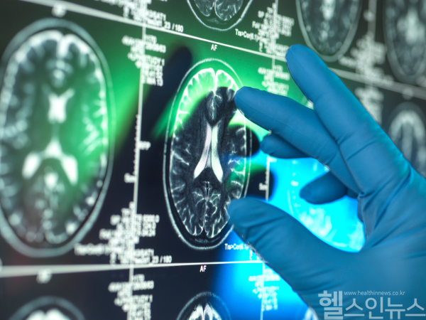 국내 뇌졸중 환자 10명 중 2명이 발생 후 1년 이내에 사망한다는 통계 자료가 발표됐다. 또 65세 이상 고령층은 1년 이내 치명률이 30%에 육박하는 것으로 확인됐다. (클립아트코리아)
