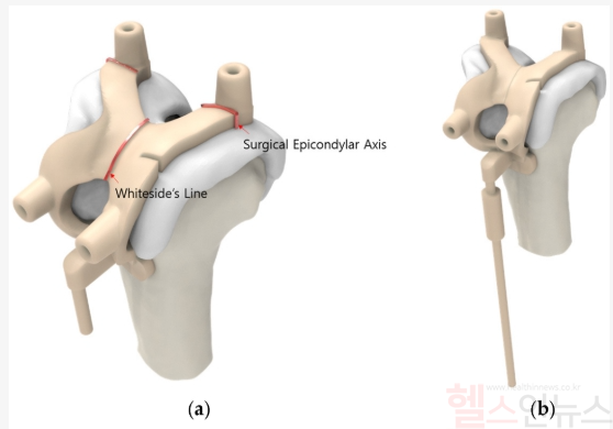 맞춤형 수술도구의 구성 요소, PSI는 수술 정확도를 극대화한다. (연세사랑병원 제공)