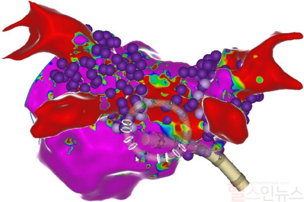 심방세동 환자의 좌심방 구조를 3차원으로 시각화한 이미지. 보라색 구체는 펄스장 절제술로 치료가 완료된 부위를 나타냄