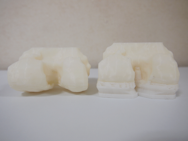 3D 시뮬레이션 인공관절 무릎 모형 (연세사랑병원 제공)