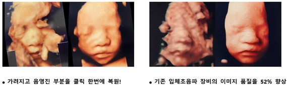 알레시오, AI 입체초음파 '클리어페이스 Pro' 선봬