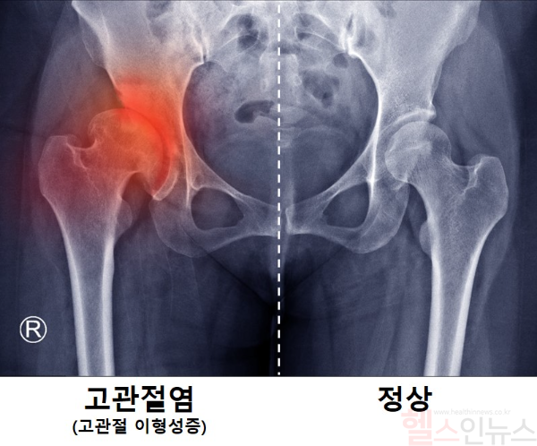 관절 이형성증으로 인한 고관절염 환자의 X-Ray. 비구가 대퇴골두를 과도하게 덮거나 충분히 덮지 않으면 고관절염이 발생함 (서울대학교병원 제공)
