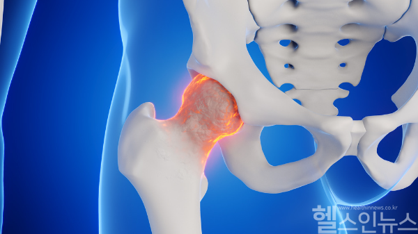 고관절 골절 환자가 2014년 3만 명이었으나 2023년 4만 명으로 증가한 것으로 확인됐다. 이는 연평균 3%가 늘어난 수치이며 남성보다 여성이 2.4배 더 많은 것으로 나타났다. (클립아트코리아)