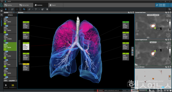 독일 HANSE를 포함한 글로벌 폐암 검진 프로젝트에 공급된 AVIEW LCS (코어라인소프트 제공)
