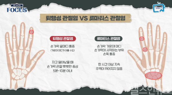 퇴행성 관절염 VS 류마티스 관절염 (서울대병원 제공)