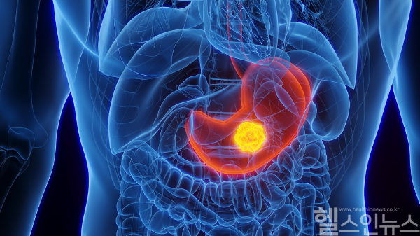위암에 따른 위절제 수술을 받은 뒤에는 건강한 회복을 위해 올바른 식습관을 지키는 것이 매우 중요하다. (클립아트코리아)