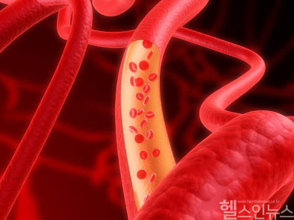 당뇨병 환자가 스텐트 시술을 받은 뒤 혈액 응고 강도가 증가되면 심혈관 재발 위험이 높아진다는 연구 결과가 발표됐다. (클립아트코리아)