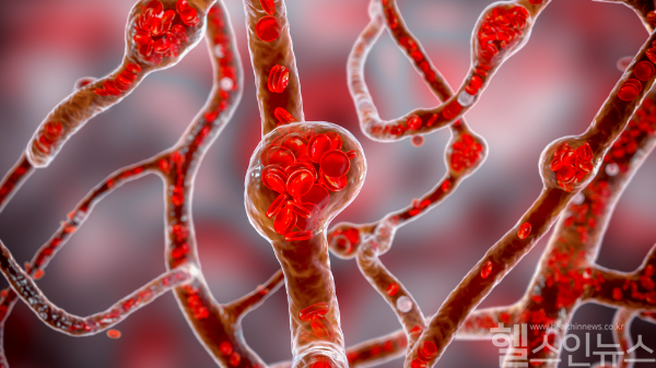 뇌 지주막하 출혈은 치사율이 50%에 다다를 정도로 초 응급 상황에 해당한다. 의심 증상이 있을 때 즉각적이고 신속한 대처가 필요하다. (클립아트코리아)