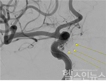 환자의 파열된 대뇌동맥류 코일색전술 사진 (센텀종합병원 제공)