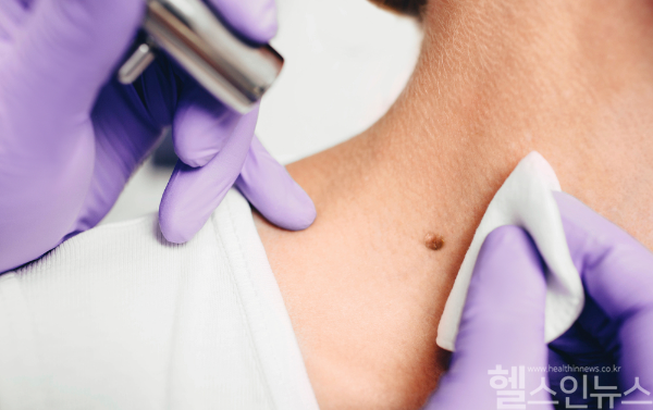 점으로 착각하기 쉬운 피부암 '흑색종'. 만약 점 크기나 색상에 변화가 시작됐다면 늦지 않게 내원해 진단받아 보는 것이 좋다. (클립아트코리아)