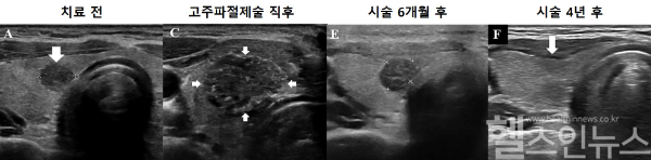 고주파절제술을 이용한 미세갑상선유두암 치료 과정. 시술 직후 괴사된 종양과 주변부가 넓게 보이지만 시간이 지나면 완전히 소멸됨. (서울대병원 제공)