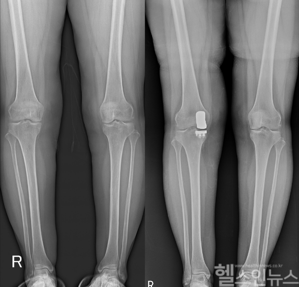 부분 인공관절 치환술은 50·60대 퇴행성관절염 환자에게 좋은 대안이다. (연세사랑병원 제공)