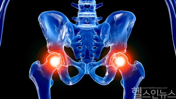 고관절에 발생하는 염증성 질환인 고관절염은 사타구니에서 통증이 발생하는 것이 특징이지만 아랫배 통증과 같이 숨겨진 신호를 보낼 수도 있어 잘 알아보는 것이 중요하다. (클립아트코리아)